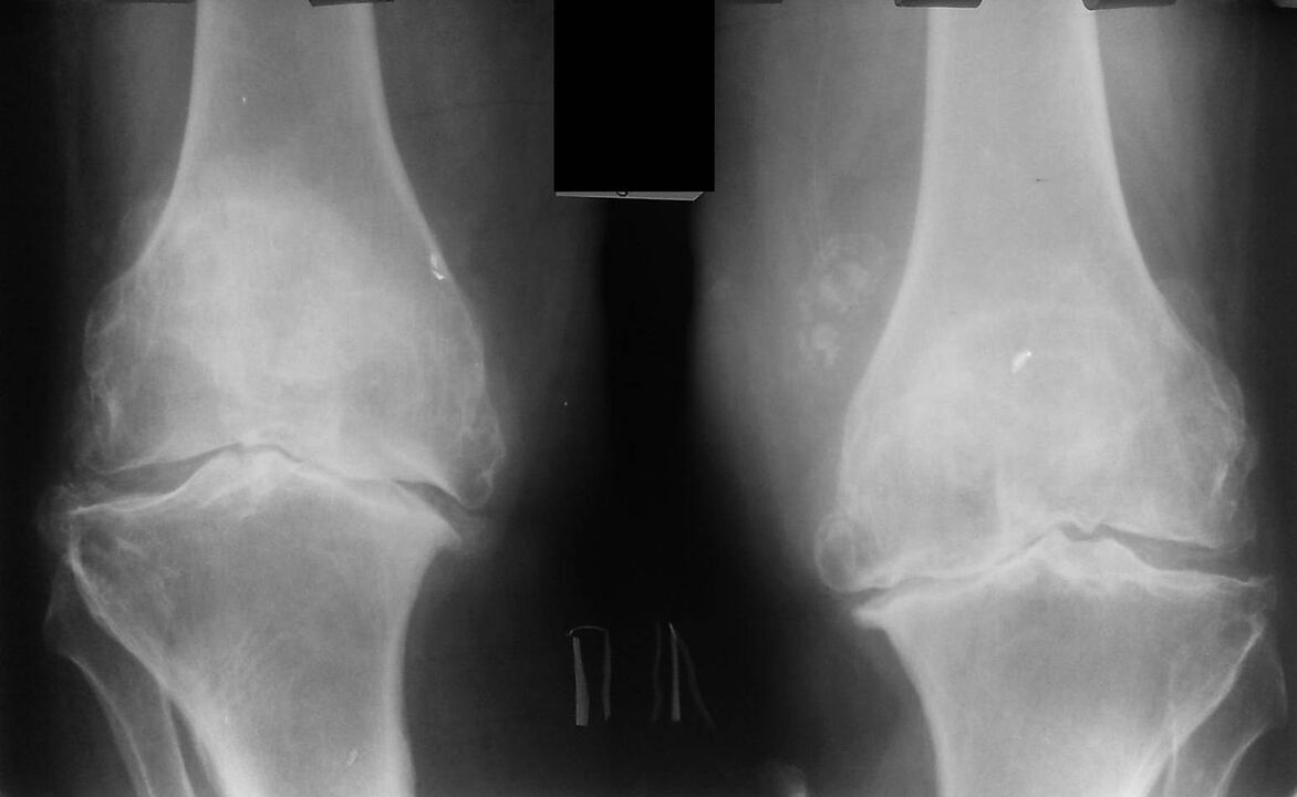 rentgen kolenních kloubů s artrózou