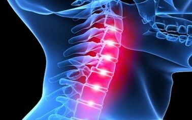 Příznaky osteochondrosy krční páteře