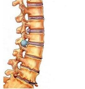 Jak se vyvíjí osteochondrosis oblasti děložního čípku