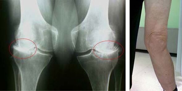artróza kolenního kloubu rentgen