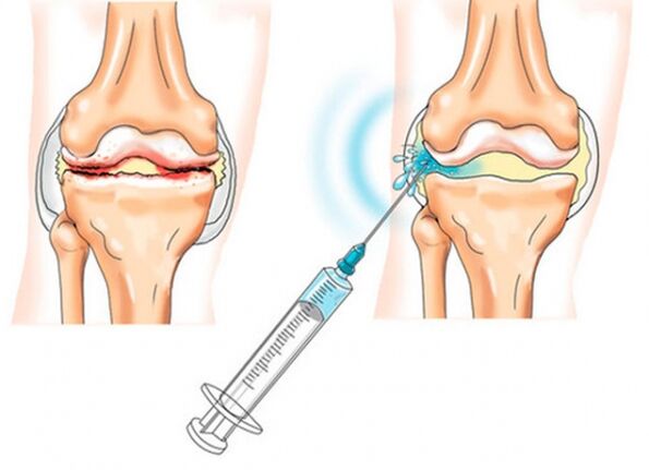 intraartikulární injekce pro kolenní artrózu