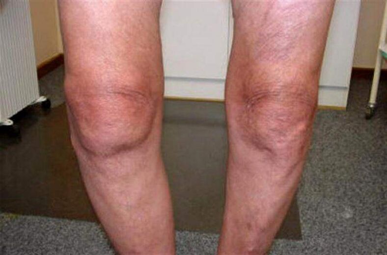 oteklé koleno v důsledku artritidy