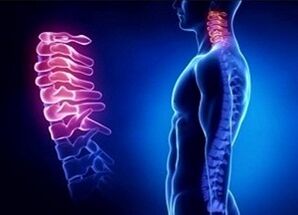 Důvody rozvoje cervikální osteochondózy