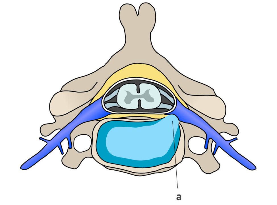 intervertebrální kýla s cervikální osteochondrózou
