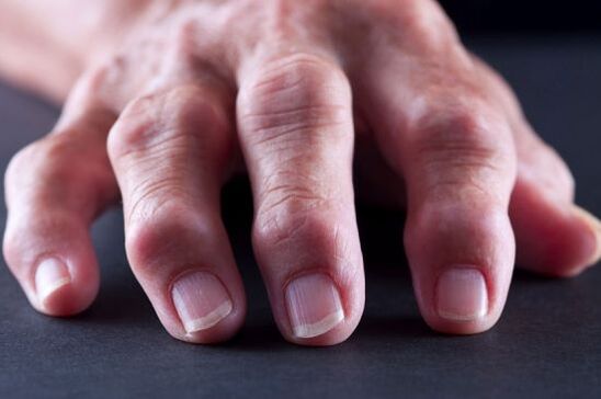 Kloubní deformity prstů v důsledku artrózy nebo artritidy